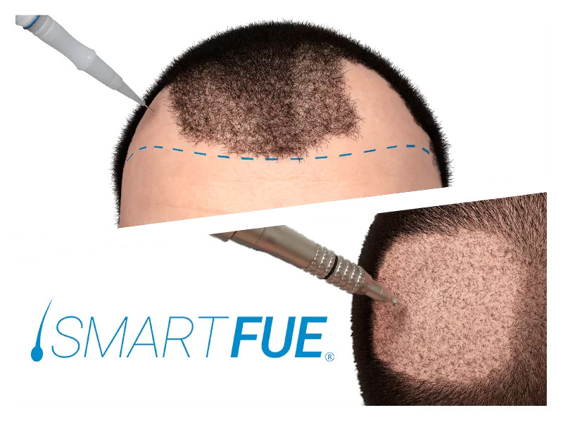 Trapianto dei Capelli - Tecnica Smart Fue Trapianto dei Capelli - Tecnica Smart Fue